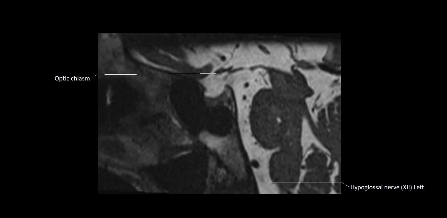 Cranial nerve sagittal anatomy MRI 3T image 30.webp